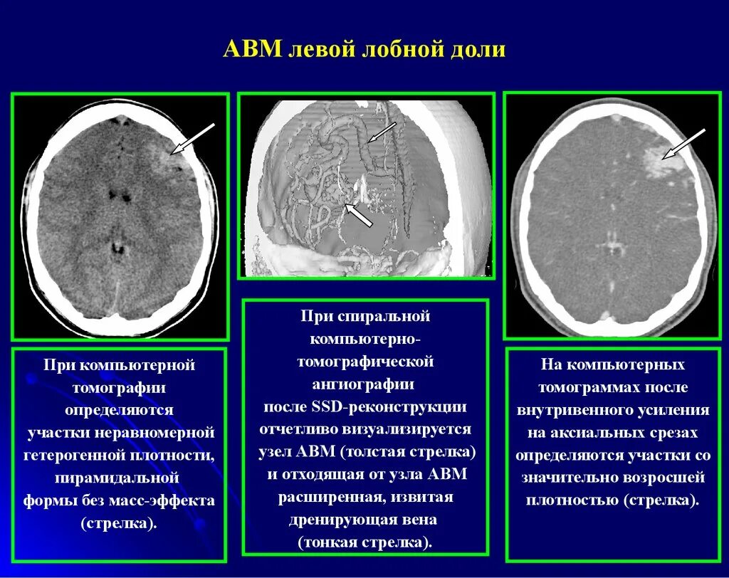 Доли мозга мрт. Сосудистые мальформации кт мрт. Сосудистая мальформация головного мозга на кт. Артериовенозная мальформация головного мозга на кт. Венозная мальформация головного мозга мрт.