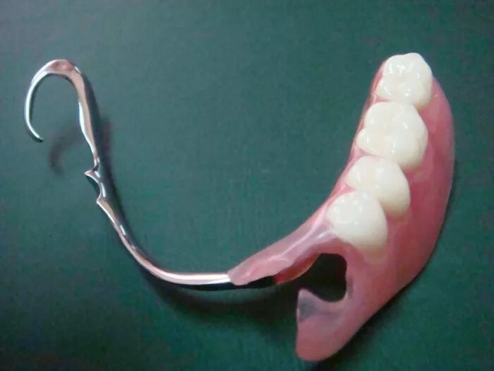 Бюгельный протез 1эзуб. Бюгельный протез (1 челюсть)+кламмер. Односторонний Нижний бюгельный протез. Бюгельный микропротез на 1 зуб. Бюгельный протез дефекты