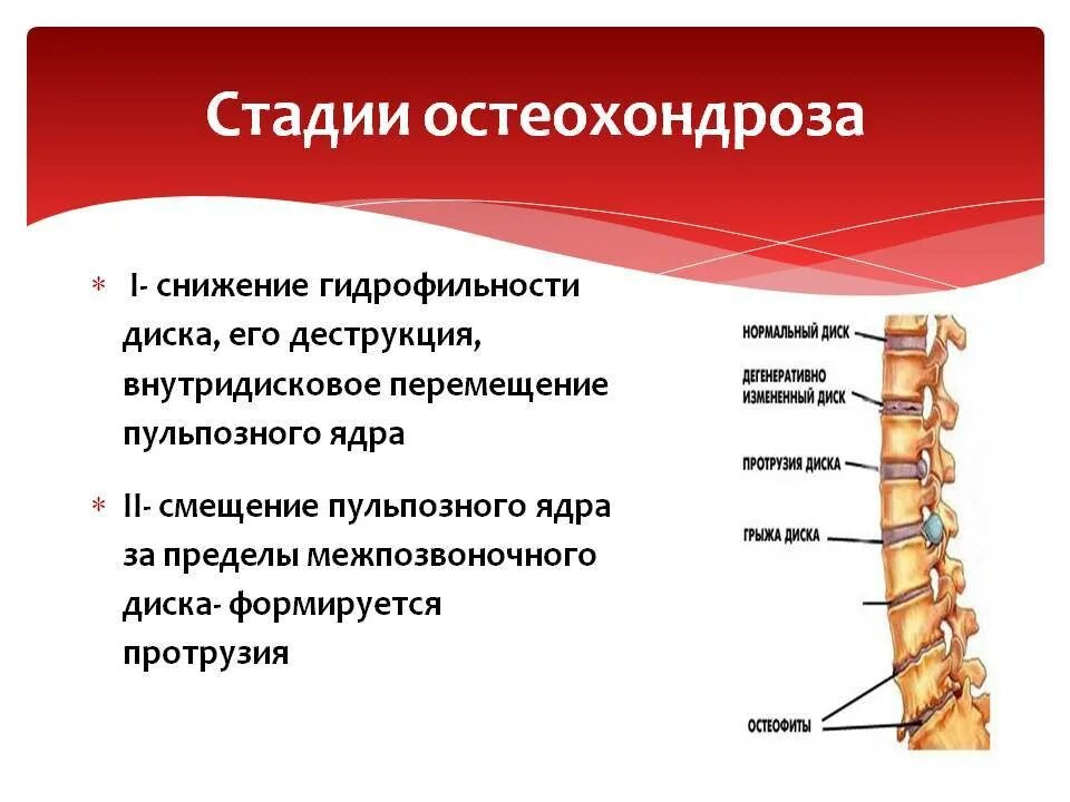 Хондроз шейного отдела позвоночника симптомы. Остеохондроз грудного отдела позвоночника 1 степени. Остеохондроз поясничного крестцового отдела 1 степени что это такое. Поясничный межпозвонковый остеохондроз 1 степени. Остеохондроз 2 степени межпозвоночных дисков грудного отдела.