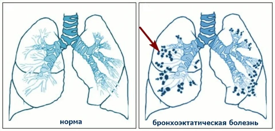 Стадии бронхоэктатической болезни. Веретеновидные бронхоэктазы кт. Бронхоэктазы классификация кт. Осложнения бронхоэктатической болезни. Стадии бронхоэктатической болезни.