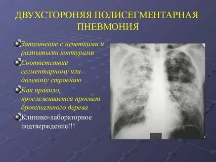 Двухсторонняя пневмония сроки выздоровления