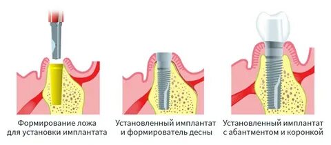 Импланты видное