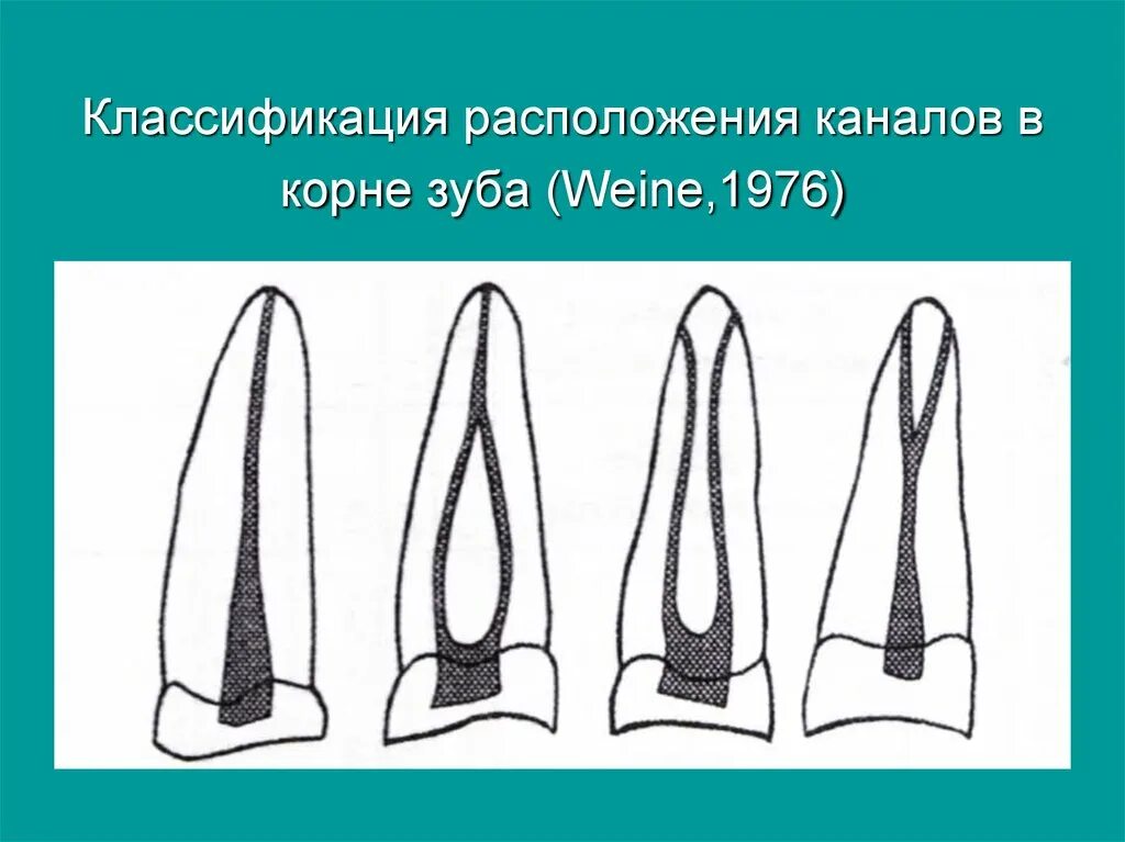 Классификация корневых каналов по Weine. Типы конфигурации корневых каналов по Weine. Типы корневых каналов зуба. Формы корневых каналов