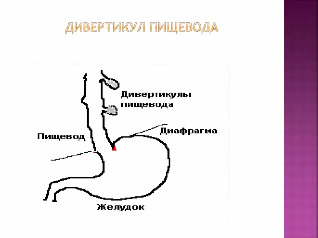 Став пищевода. Дивертикул желудка рентген. Дивертикулы пищевода классификация. Локализация дивертикулов пищевода. Псевдодивертикул пищевода.