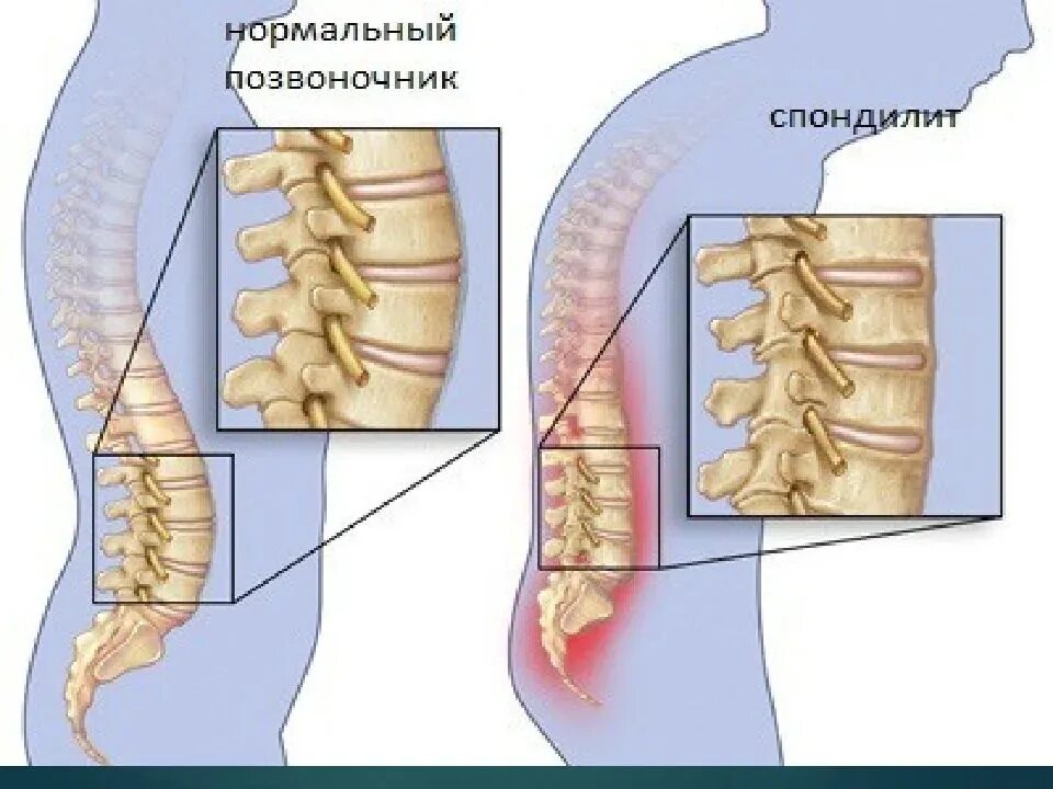 Спондилеза спондилоартроза поясничного отдела позвоночника. Спондилоартроз th12-l5 позвонков. Позвоночника спондилоартрозе пояснично-крестцового. Анкилозирующий спондилез это болезнь Бехтерева. Болезнь Бехтерева шейного отдела позвоночника.