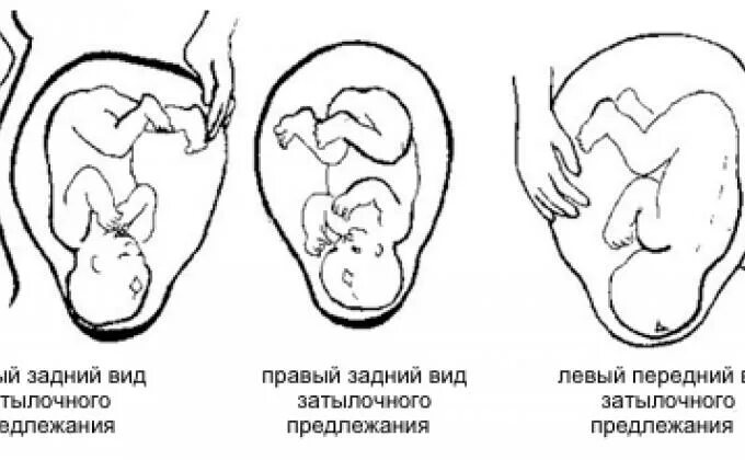 Ребенок расположен справа. Головное предлежание 1 позиция передний вид. Головное затылочное предлежание. Позиции ребенка в животе. Расположение ребенка.