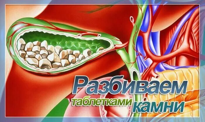 Лекарство от камней в желчном пузыре. Таблетки от камней в желчном. Препараты для желчного пузыря с камнями. Таблетки для желчного пузыря с камнями. Средство от камней в желчном пузыре