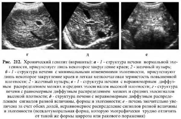 Перипортальный фиброз печени на УЗИ. Фиброз печени на УЗИ протокол. Первичный портальный фиброз печени УЗИ. УЗИ признаки цирроза печени протокол.