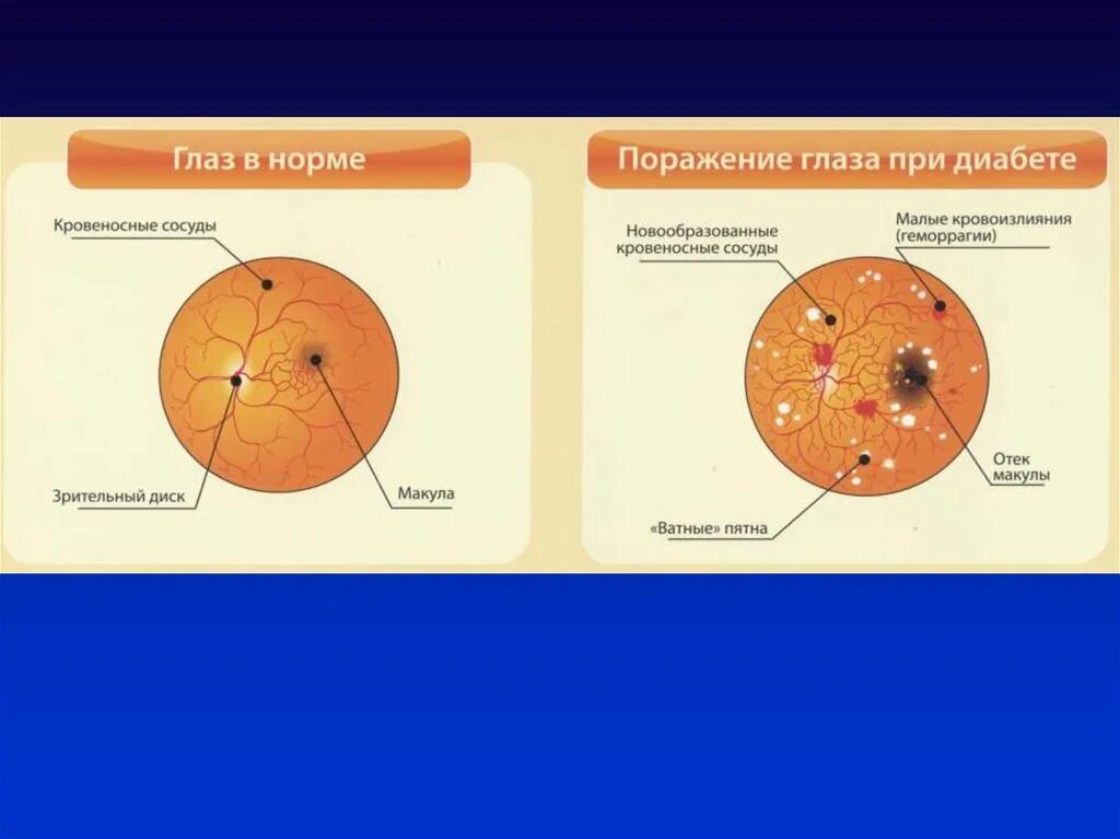 Диабет 1 и 2 типа. Сахарный диабет отличия. Сахарный диабет первого и второго типа разница. Диабет 1 и 2 типа отличия.