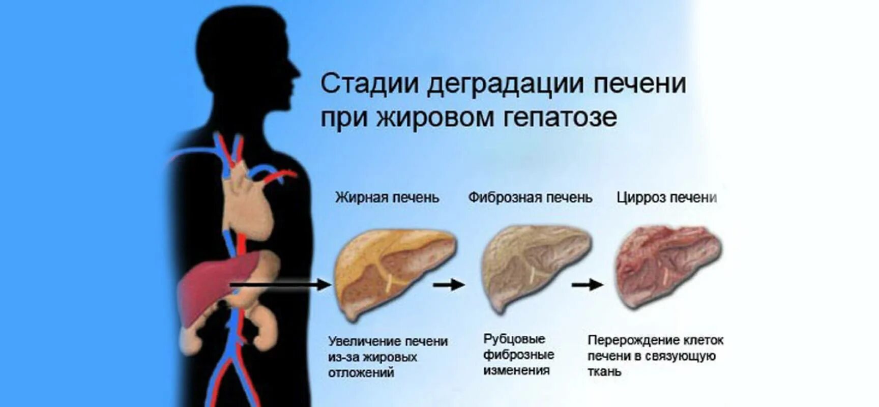 Жировой гепатоз печени. Симптомы жирового гепатоза печени. Повышен железа печень