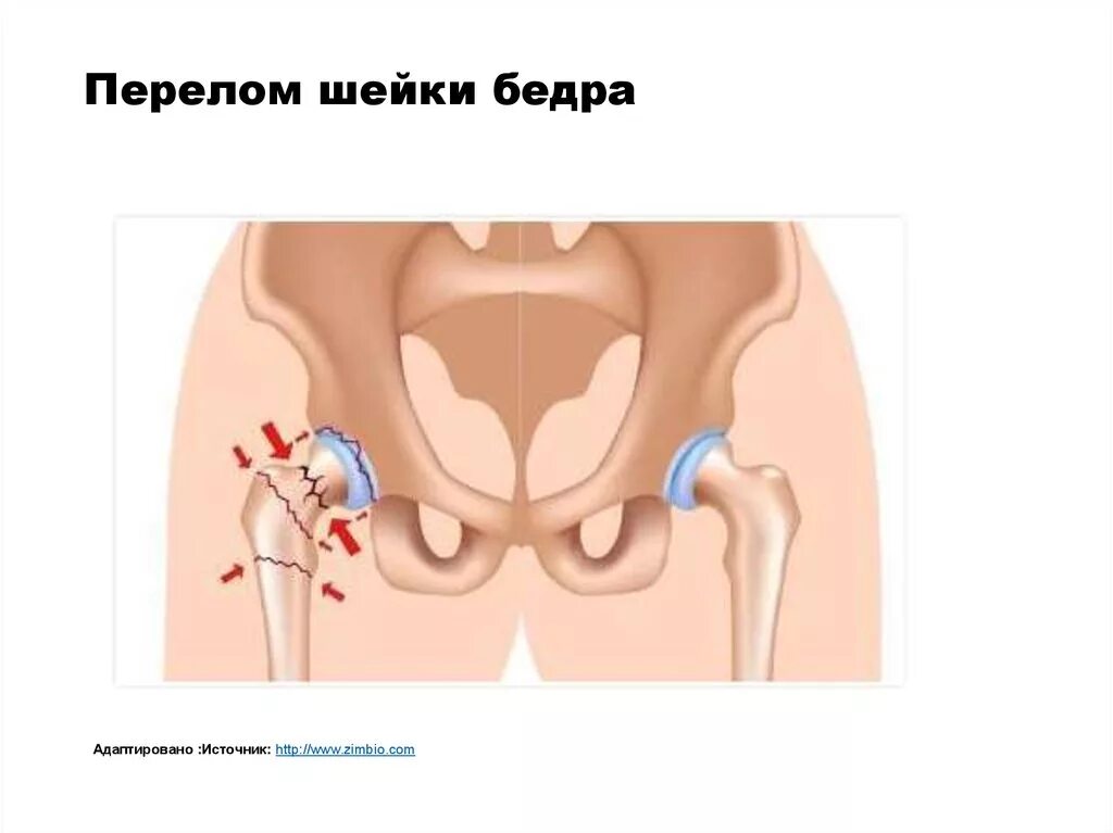 Шейка бедра симптомы и лечение. Буклет профилактика перелома шейки бедра.