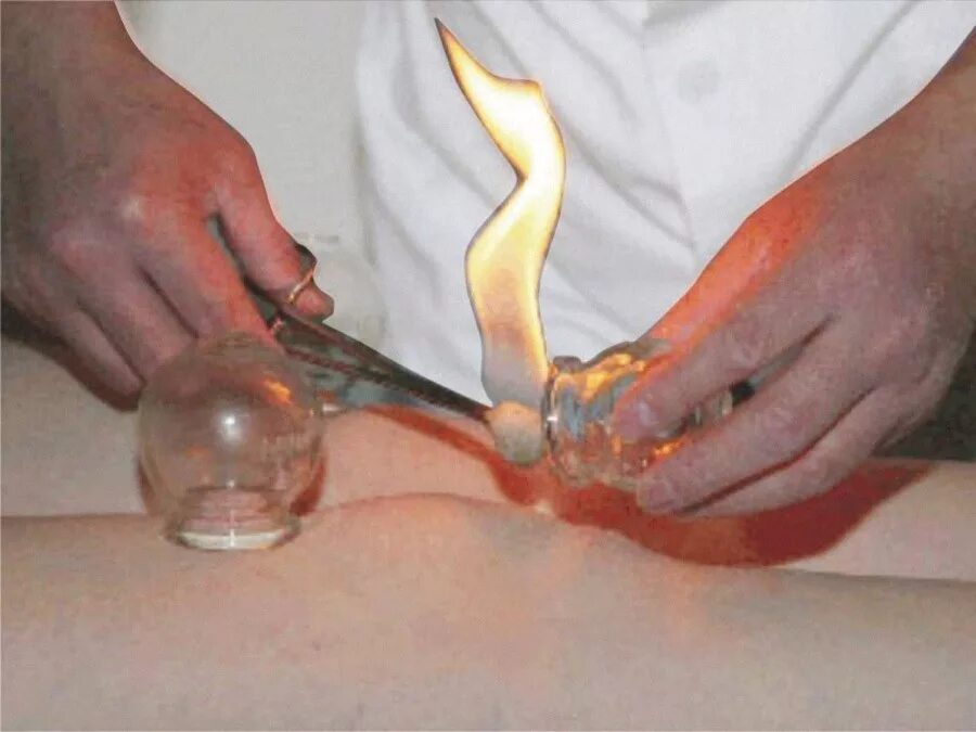 установка банок