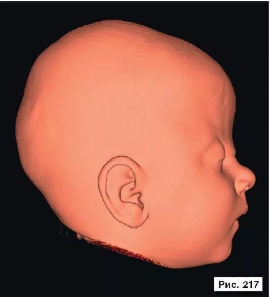 Скафоцефалия у новорожденных. Краниостеноз тригоноцефалия операция. Лобные кости выпирают у ребенка.