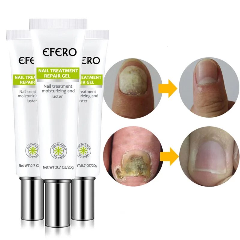 Крем для ногтей. Fungus treatment cream. Мазь nail repair cream. Крем для ногтей. Fungus treatment cream.