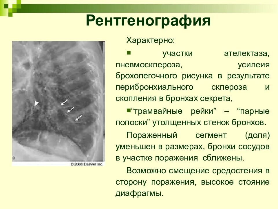 Диффузное дыхание характерно для. Пневмосклероз рентген признаки. Рентген признаки пневмофиброза. Пневмосклероз легких рентген признаки. Бронхоэктатическая болезнь рентген.