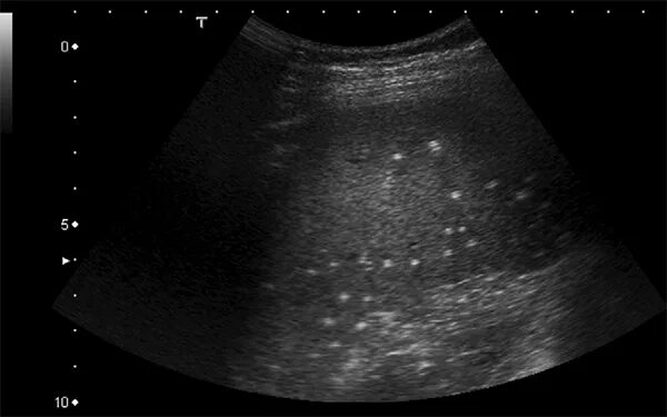 билиарная гамартома узи. кальцинаты в селезенке. кальцинат щитовидной железы узи. микрокальцинаты в печени на узи. кальциноз селезенки на узи.