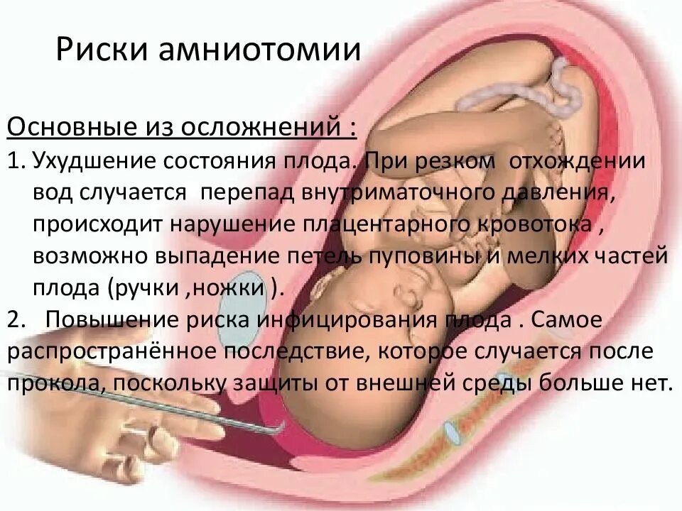 Прокол пузыря сколько схватки. Прокол околоплодного пузыря. Протыкание плодного пузыря. Прокол пузыря амниотомия плодного.