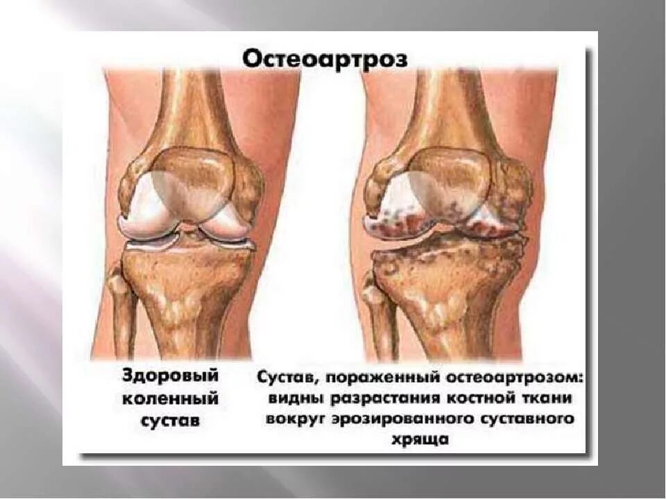 Сустав 1а. .Деформирующий остеоартрит остеоартроз. Гонартроз 1 степени коленного сустава что это такое.