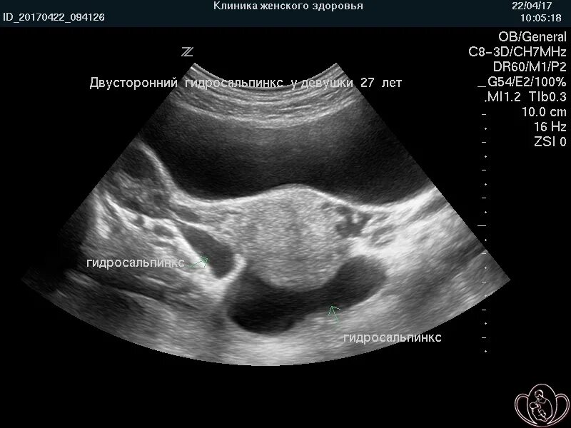 Гидросальпинкс лечение операции. УЗИ снимки гидросальпинкса. УЗИ картина гидросальпинкса. УЗИ малого таза при гидросальпинксе. Гидросальпинкс ремиссия.
