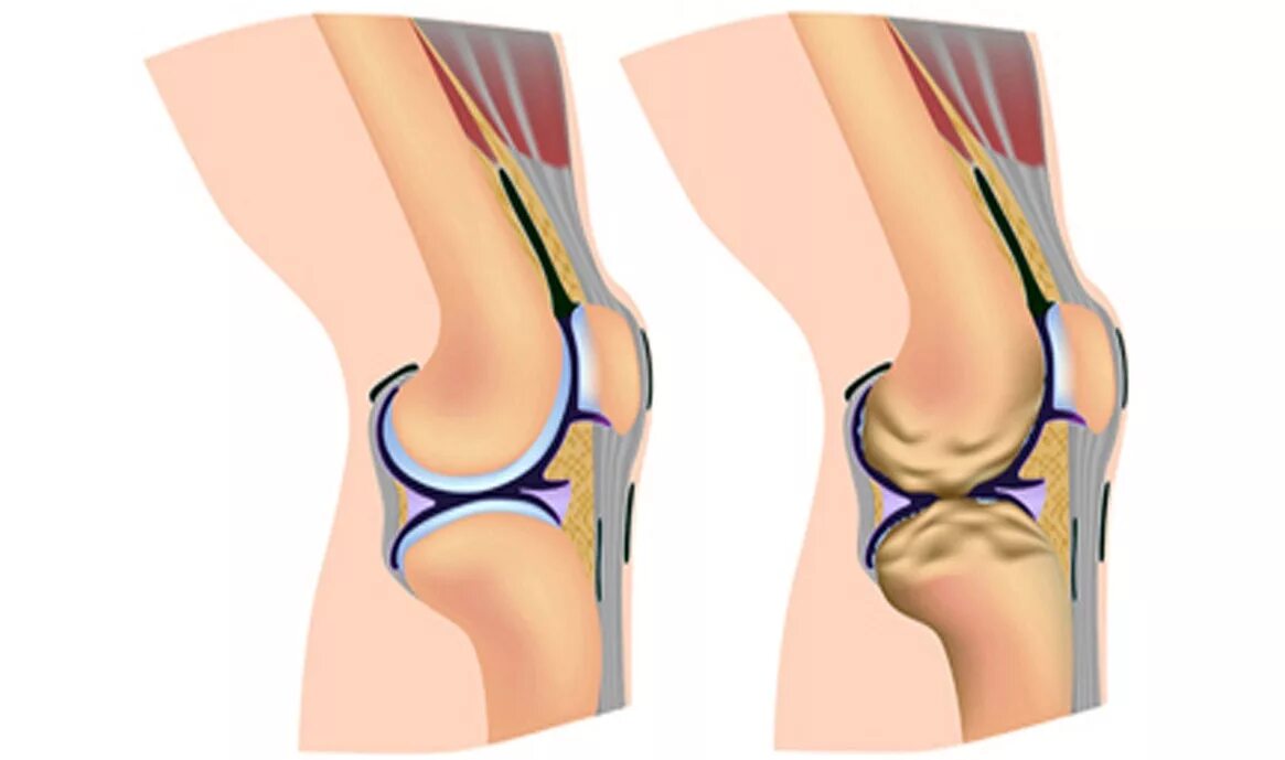 Гонартроз коленного сустава лечение препараты
