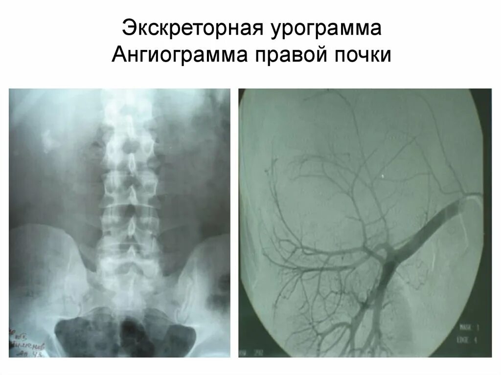 Ангиограмма при поликистозе почек. Транслюмбальная ангиография. На экскреторной урограмме выявлена деформация чашечек левой почки. Экскреторное дерево почки