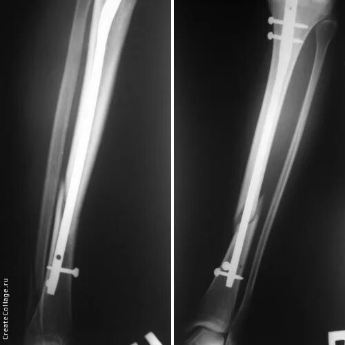 блокируемый интрамедуллярный остеосинтез. экстрамедуллярный остеосинтез голени. интрамедуллярный остеосинтез бедренной кости. интрамедуллярный остеосинтез большеберцовой кости. интрамедуллярный остеосинтез большеберцовой кости.
