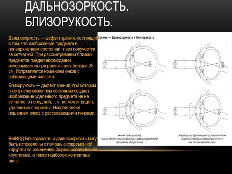 Дальнозоркость. Причины дальнозоркости. Зрение дальнозоркость. Физиологическая дальнозоркость. Болезнь дальнозоркость