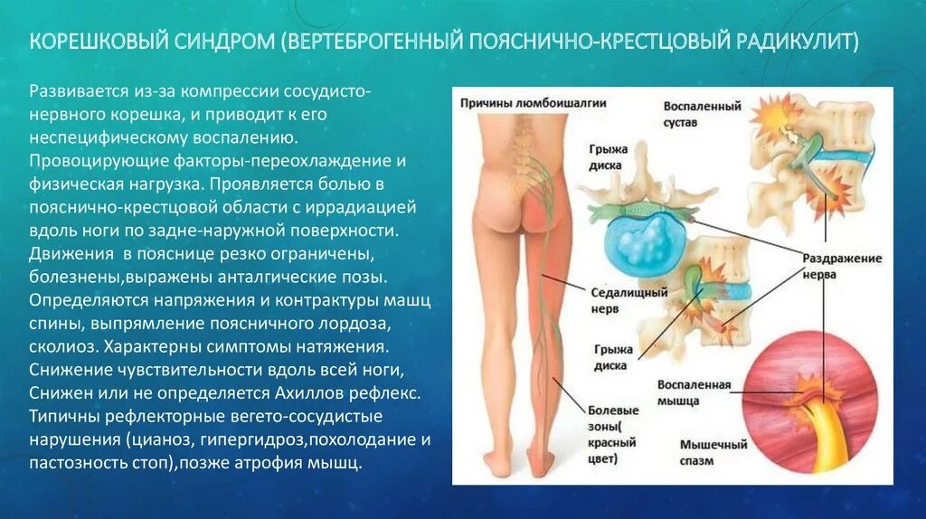 Корешковый синдром. Корешковый синдром симптомы. Корешковый синдром поясничного отдела. Клинические проявления корешкового синдрома.