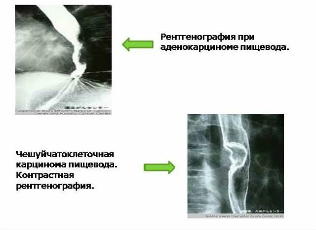 Рентгеноскопия пищевода подготовка