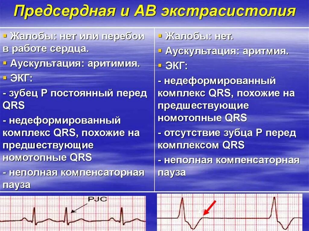 Экстрасистолия сердца симптомы и лечение у взрослых. Аритмия и экстрасистолия на экг. экг норма и экстрасистолия. политопные экстрасистолы на экг. пароксизмальная желудочковая экстрасистолия на экг.