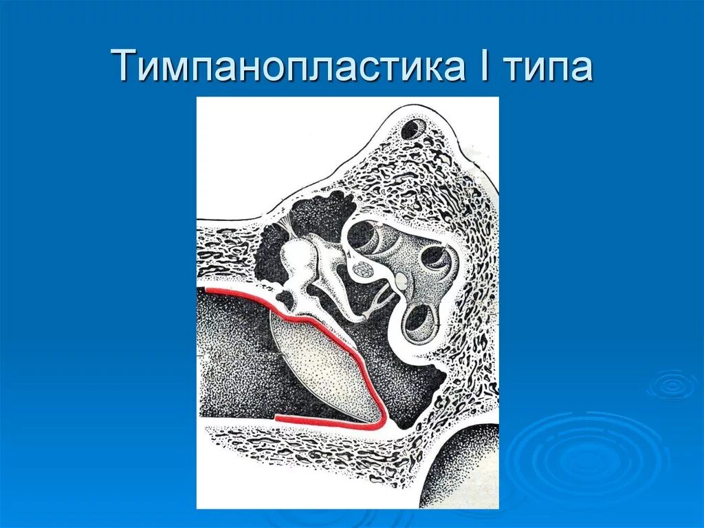 Операция на среднем ухе. Тимпанопластика, мирингопластика. Тимпанопластика по Вульштейну. Тимпанопластика барабанной перепонки. Тимпанопластика 1 типа этапы операции.