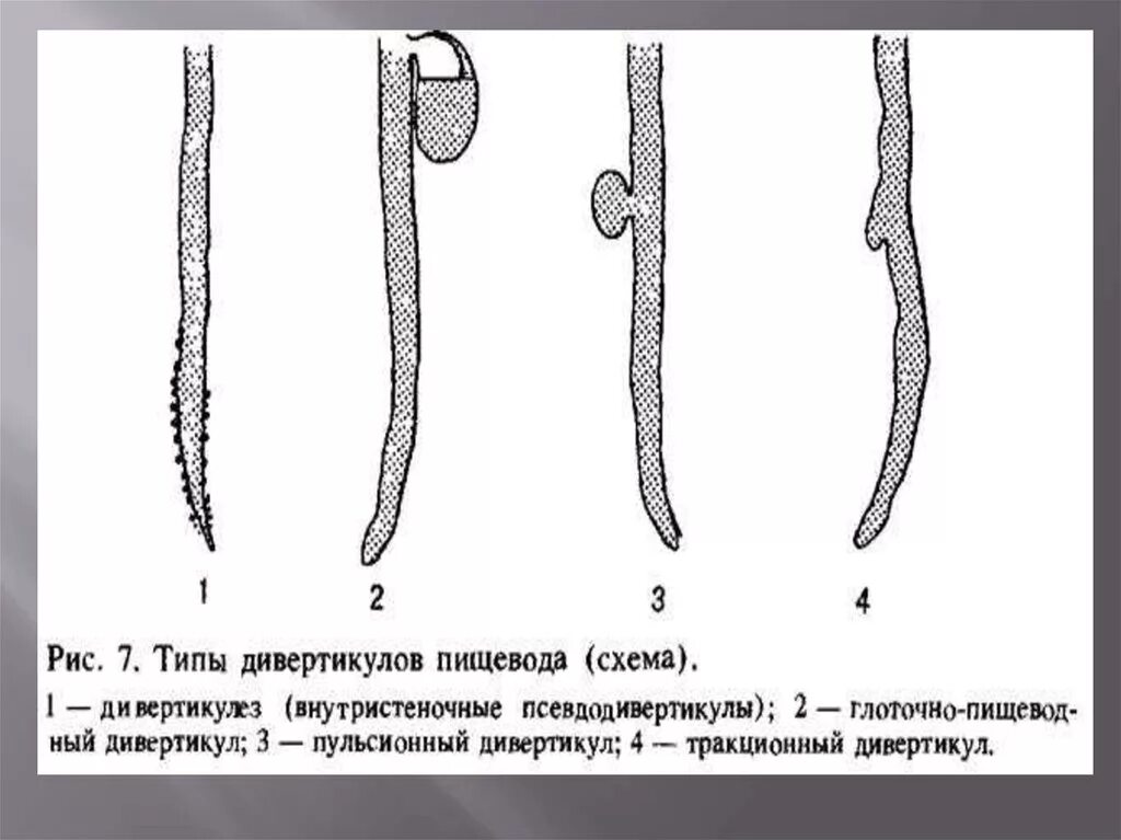 Дивертикул гистология. Дивертикул гистология