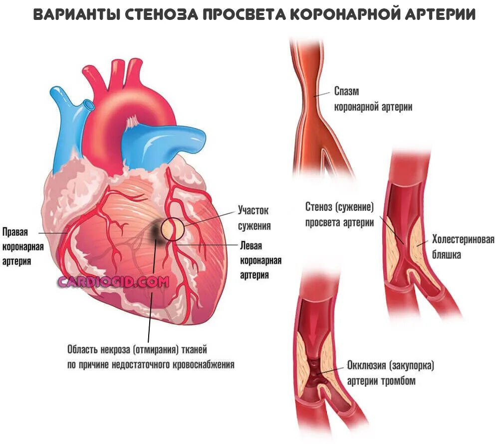 Сужение сосудов симптомы лечение. Коронарные артерии сужения корон. Гемодинамически значимый стеноз коронарных артерий. Ишемическая болезнь инфаркт миокарда. Ишемическая болезнь сердца стенокардия инфаркт миокарда.