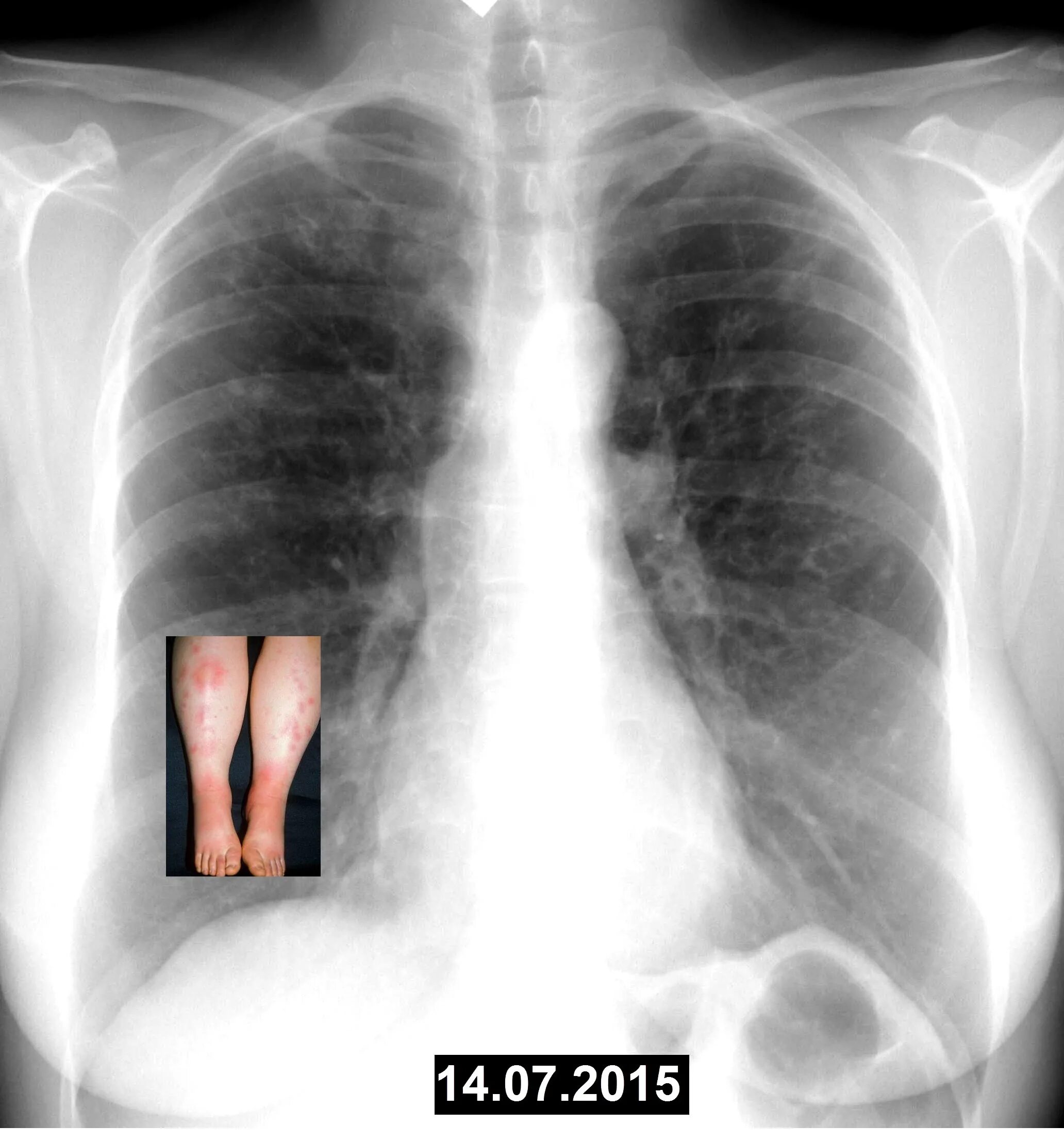 20 процентов легких. Снимок двухсторонней пневмонии. Двухсторонняя пневмония рентген. Двухстороннее воспаление лёгких. Рентген легких пневмония двухсторонняя.