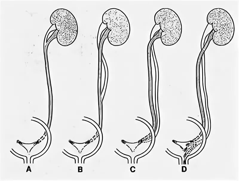 Два мочеточника. Эктопия устья мочеточника. Интрамуральная эктопия мочеточника. Неполное удвоение почки. Неполное удвоение мочеточника.