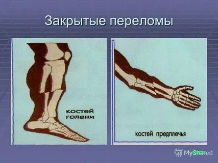 Опасные переломы