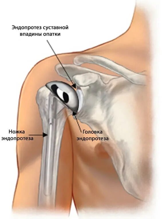 Эндопротез плечевого сустава Тотальный реверсивный. Эндопротез головки плечевой кости. Реверсивное эндопротезирование плечевого сустава. Эндопротез шейки плечевой кости. Операция по замене плечевого сустава
