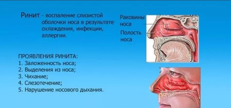 Насморк заложенность носа. Воспаление слизистой оболочки носовой полости.