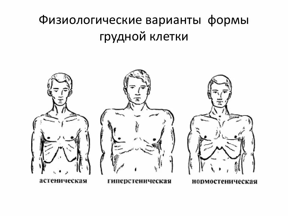 Грудная клетка у ребенка норма. Нормостенический Тип грудной клетки. Гиперстеник форма грудной клетки. Астеническая гиперстеническая и нормостеническая грудная клетка. Формы грудной клетки в норме и патологии.