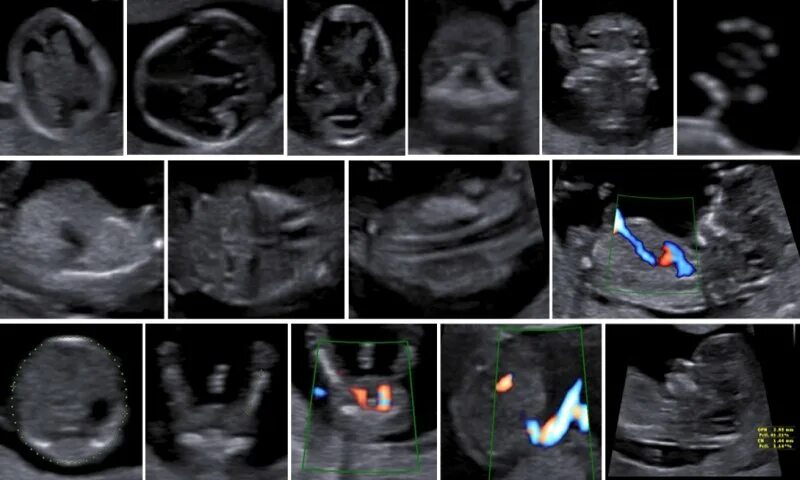 Узи аномалий. Пороки развития плода на УЗИ. УЗИ патологии плода 1 триместр. Пороки развития на первом скрининге.