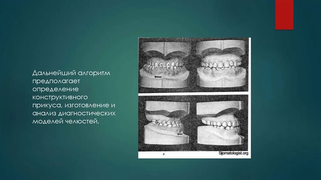 Исследование диагностических моделей в артикуляторе. Методы диагностики в ортодонтии. Анализ диагностических моделей. Анализ диагностических моделей. Исследование на диагностических моделях челюстей.