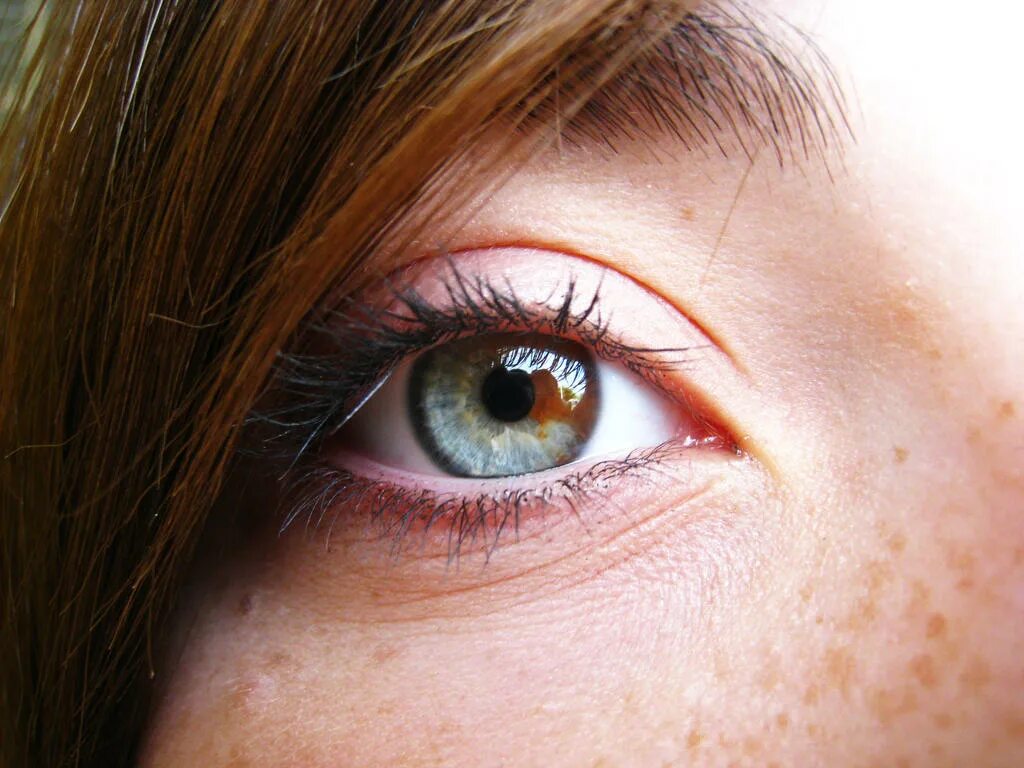 Пестрые глаза. Металлозная гетерохромия. Секторная гетерохромия глаза у человека. Неполная гетерохромия глаз. Секторная гетерохромия (частичная).