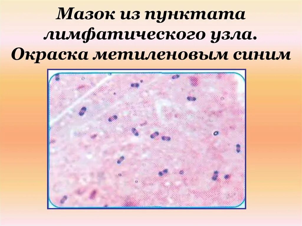 Цитологическое исследование пунктата. Мазок из пунктата лимфатического узла. Цитологическое исследование лимфатических узлов. Микроскопическое исследование пунктата лимфатических узлов.