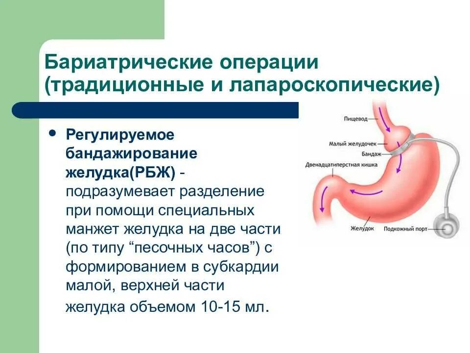 Бариатрическая операция екатеринбург. Бариатрическая операция гастрошунтирование. Бариатрическая операция на желудке. Лапароскопическое регулируемое бандажирование желудка. Бариатрическая операция бандажирование желудка.