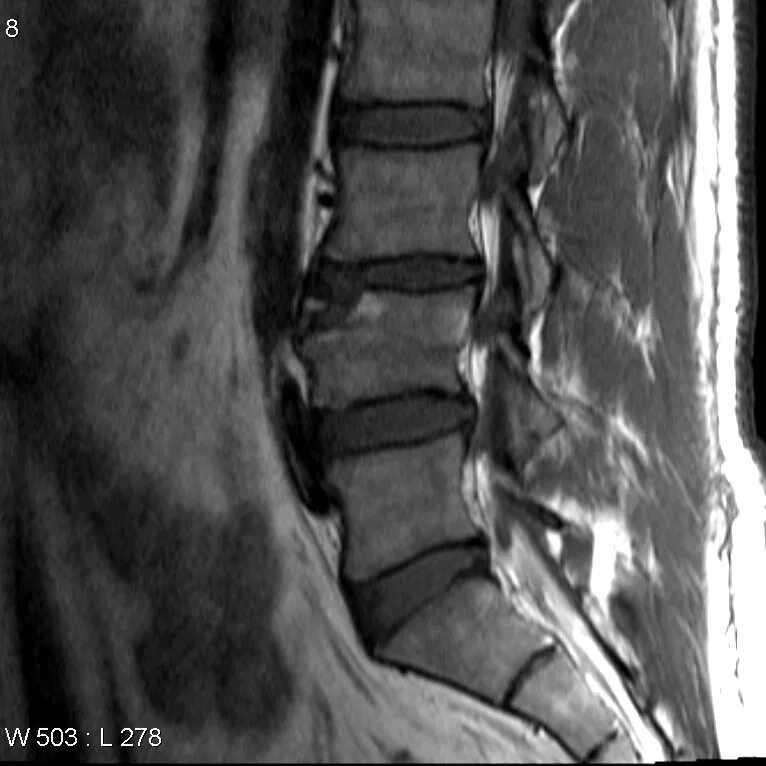 Limbus vertebra l4 позвонка. Лимбус Вертебра l3. Лимбус тела позвонка. Limbus vertebra мрт.