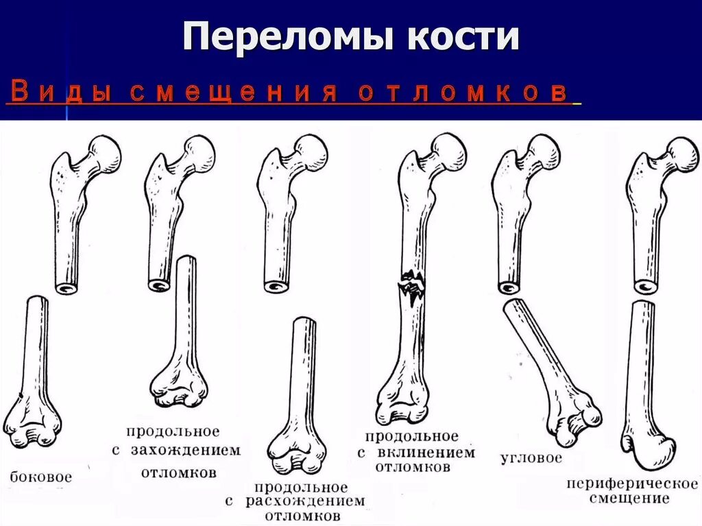 Перелом кости может быть каким. Схема переломов трубчатых костей. Классификация переломов трубчатых костей. Классификация переломов по характеру повреждения кости. Классификация переломов длинных трубчатых костей.