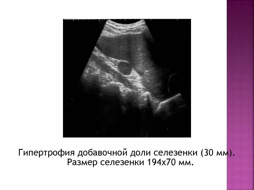 Добавочная селезенка на УЗИ. Добавочная долька селезенки на кт.