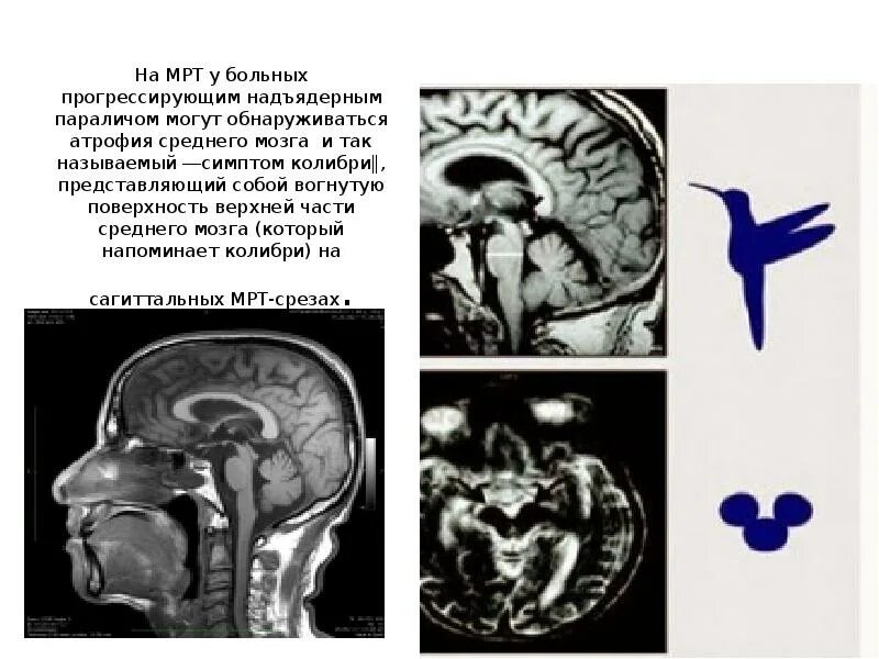 Умеренная атрофия мозга. Мультисистемная атрофия головного мозга на мрт. Прогрессирующий надъядерный паралич. Дегенерация головного мозга. Атрофия среднего мозга.