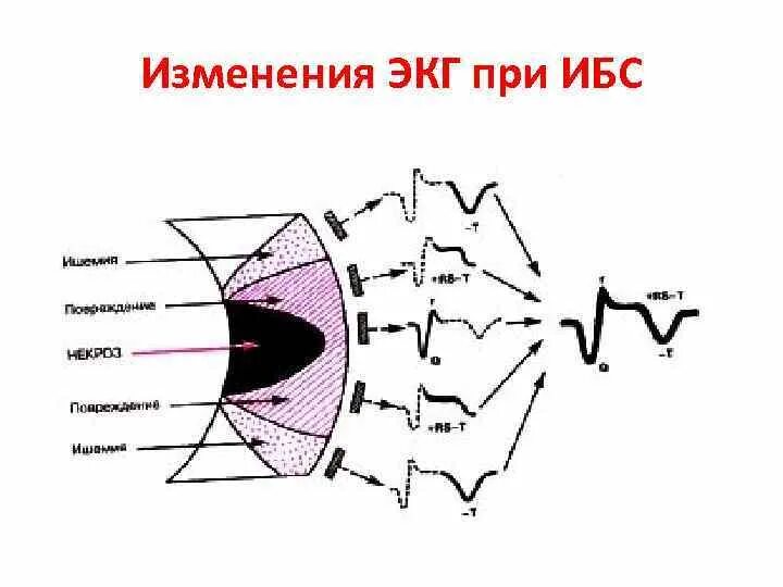 Ишемия боковой стенки. ИБС на ЭКГ. Изменения на ЭКГ при ишемической болезни сердца. Специфические изменения на ЭКГ при ИБС. Кардиограмма при ишемической болезни сердца.