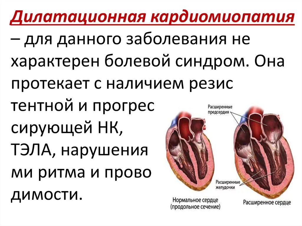 Причины дилатационной кардиомиопатии. Кардиомиопатии дилатационная. Клинические проявления дилатационной кардиомиопатии. Дилатационная кардиомиопатия критерии диагноза. Причины дилатационной кардиомиопатии.